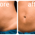 beforeafter