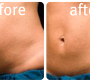 beforeafter