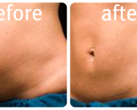 beforeafter